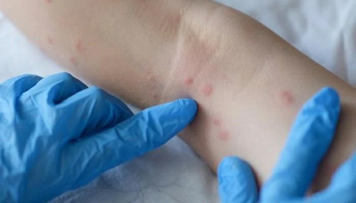Epidémie de la « variole du singe » : L’OMS tire la sonnette d’alarme