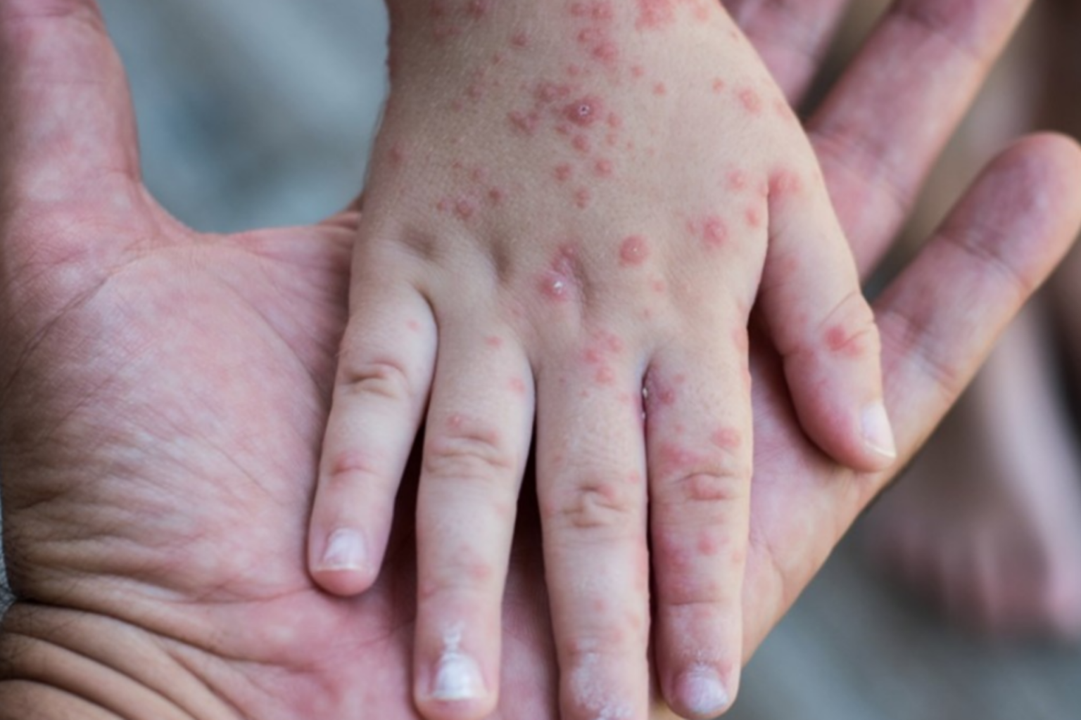 Le Maroc à l’épreuve de la rougeole : L’épidémie exige une campagne de vaccination. La mobilisation de la tutelle est-elle au niveau du défi ?